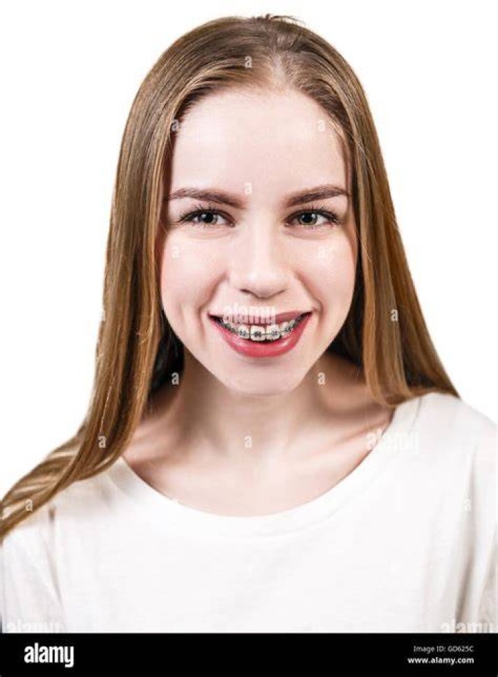 a woman with braces on her teeth posing for a photo in front of fireworks