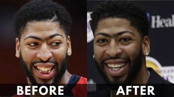 Anthony Davis Teeth Fixed Before And After TeethWalls
