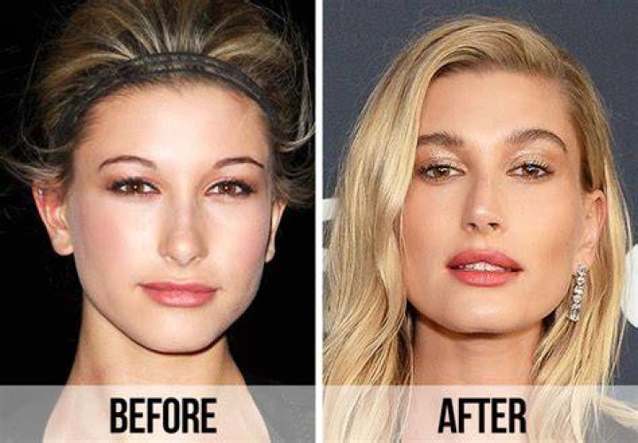 Hailey Bieber Nose Job An InDepth Look Cosmeticium