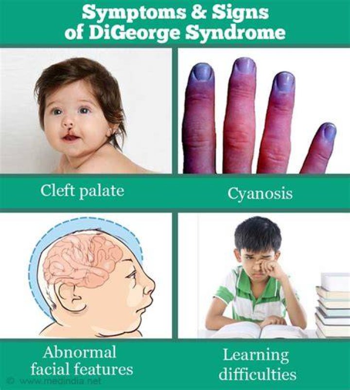 Unveiling The Triumphs And Challenges Of DiGeorge Syndrome: Insights From Famous Faces